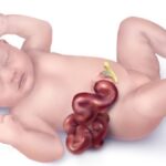 Understanding Gastroshiza: Causes, Symptoms, and Treatment Options